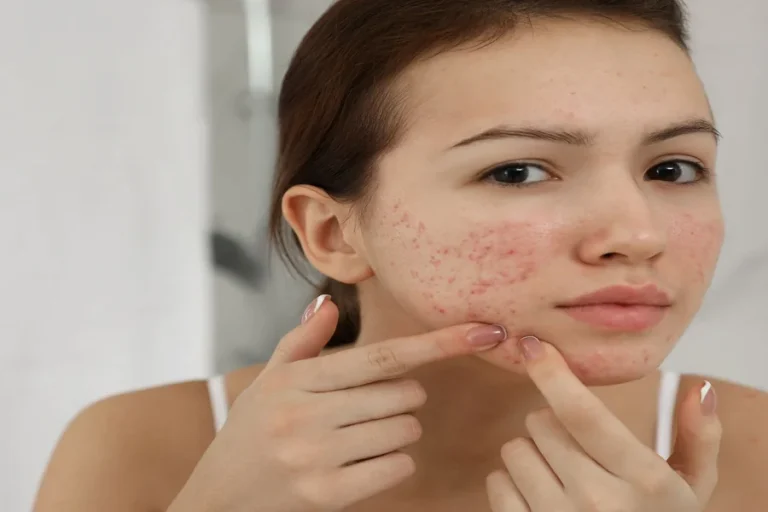 6 Treatment Options in Houston for Managing Acne Breakouts